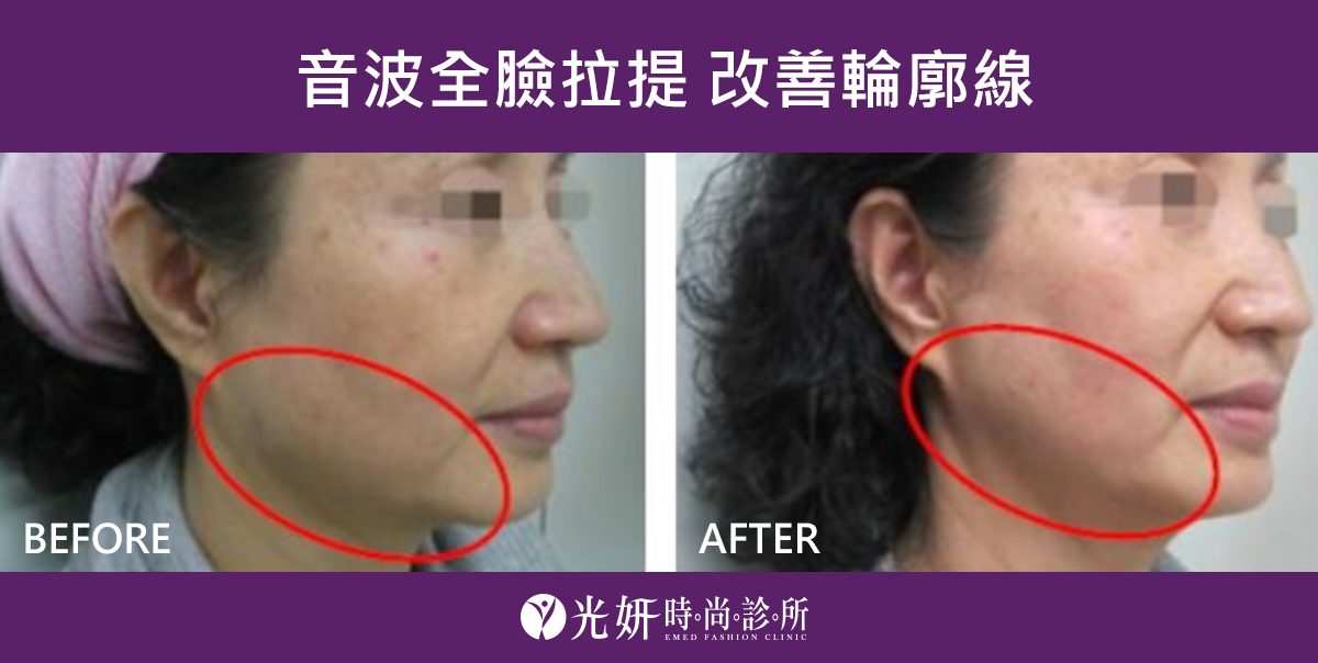 音波全臉拉提 改善輪廓線