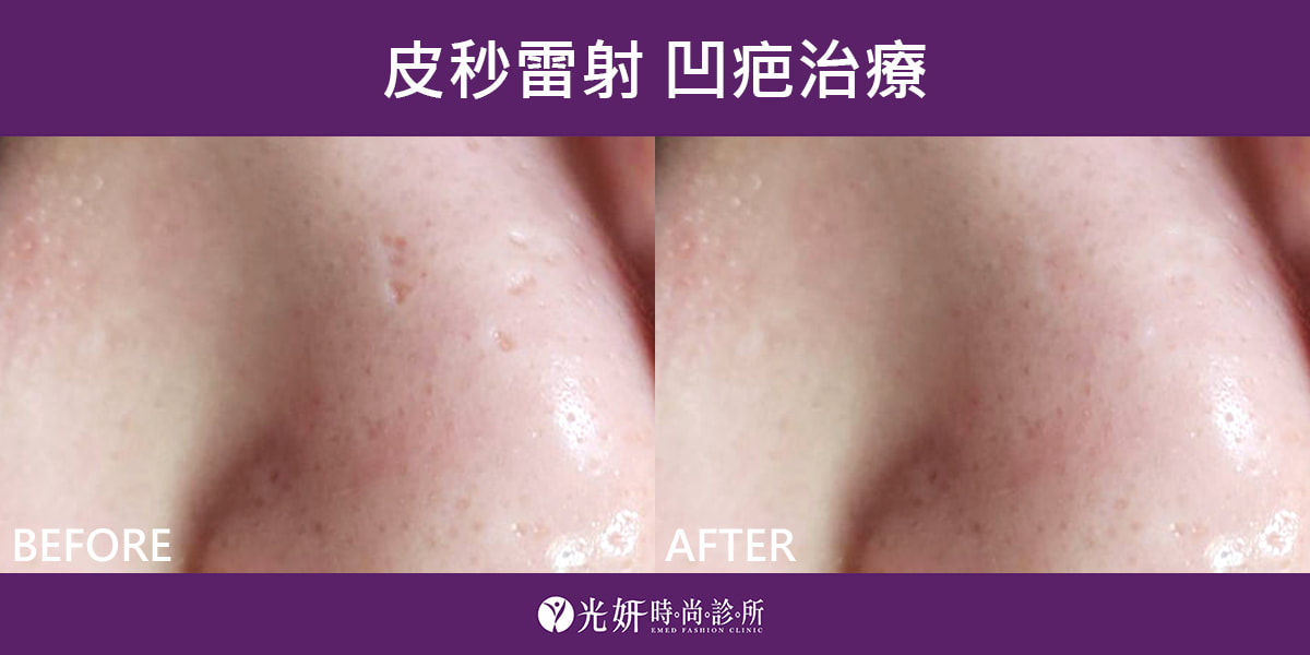 本院皮秒雷射實例分享 圖片 2