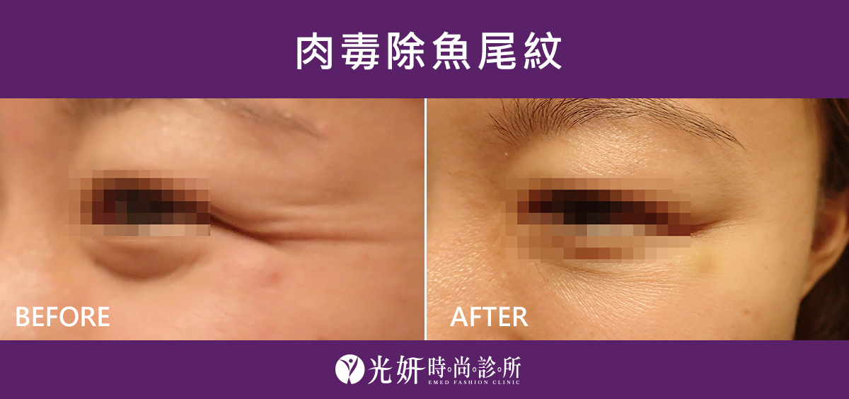 本院肉毒治療實例分享 圖片 3