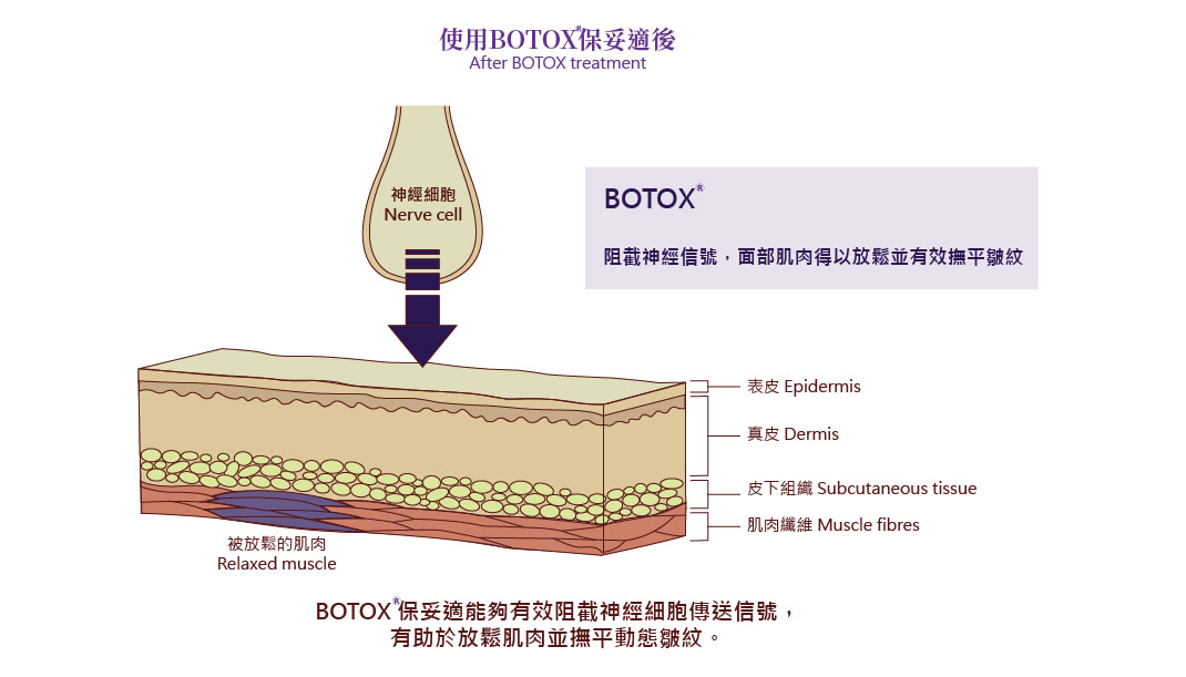 肉毒桿菌素注射 圖片 5