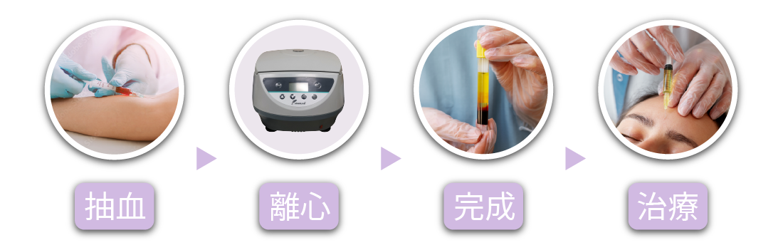 自體血小板增生療法 圖片 2