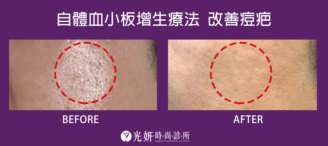 自體血小板增生療法 圖片 1