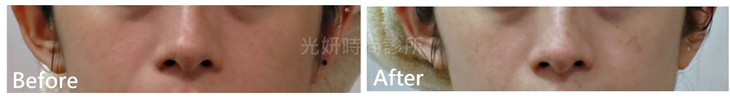 淨膚淡斑雷射 圖片 3