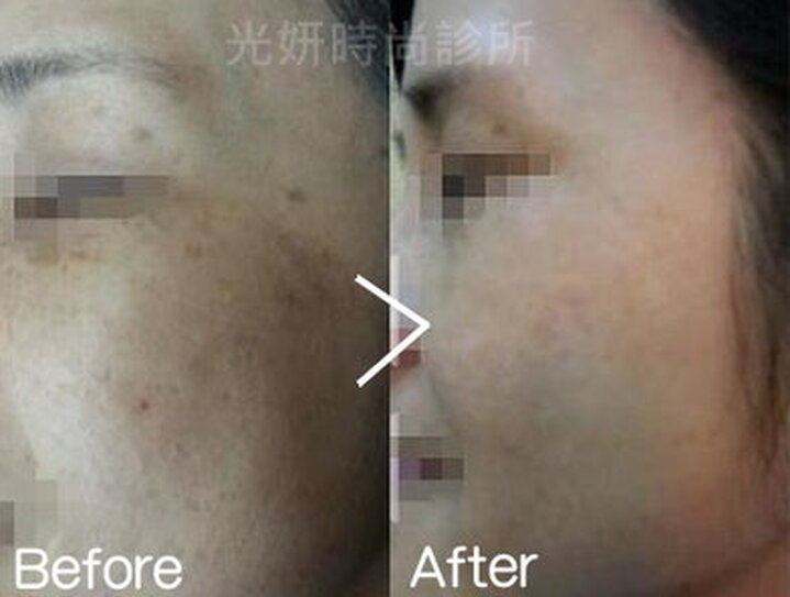 淨膚淡斑雷射 圖片 4