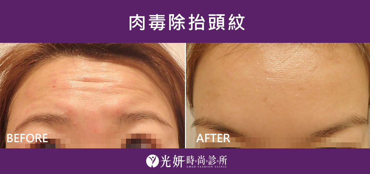 肉毒桿菌素注射 圖片 9